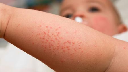 Preventing baby skin rashes